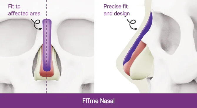 A Fit-Me custom implant on the bone and cartilage of the nose, seen from the front and from the side
