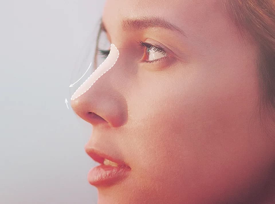 A custom implant shaped to the profile of a nose